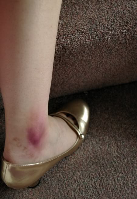 bruises4.jpg